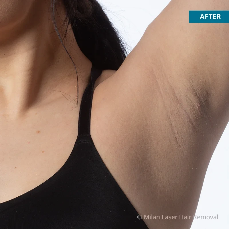 Underarm Before & After Photos of Laser Hair Removal | Milan Laser in  Baltimore, MD